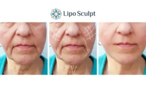 Explaining Morpheus8 And What It Can Do For You 3 Boost your confidence with Morpheus8 Wallingford call our team today!