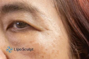 Cryopen: The Revolutionary Treatment for Age Spots Unveiled 2 Are age spots Wallingford giving you low self esteem? Contact us today!